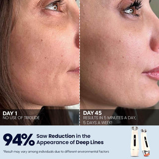 Triglide facial rejuvenation device - EMS, RF, and LED technology, Results, After Before