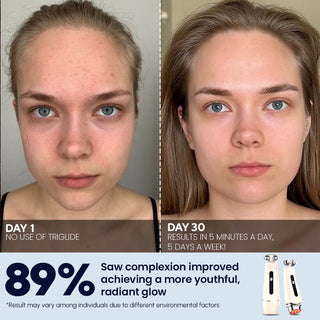Triglide facial rejuvenation device - EMS, RF, and LED technology, Results, After Before