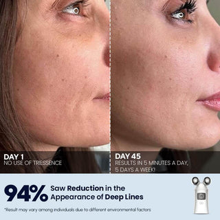 TriEssence facial rejuvenation device - EMS, Microcurrent, and LED technology, Results, After Before