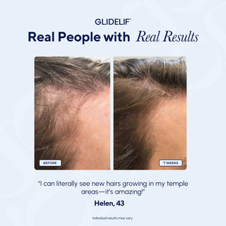 Before and after comparison of hair growth with Glidelif, featuring a quote from a user named Helen.