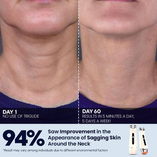 Triglide facial rejuvenation device - EMS, RF, and LED technology, Results, After Before